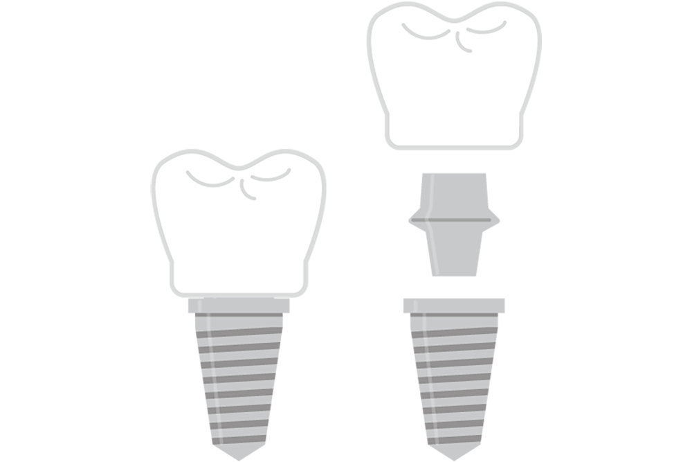 インプラント治療の特徴
