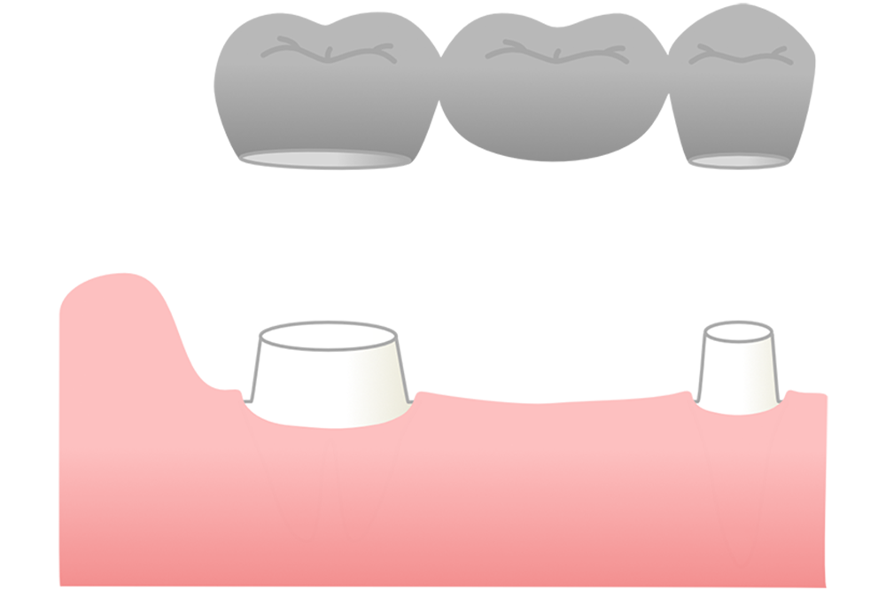 ブリッジ治療の特徴